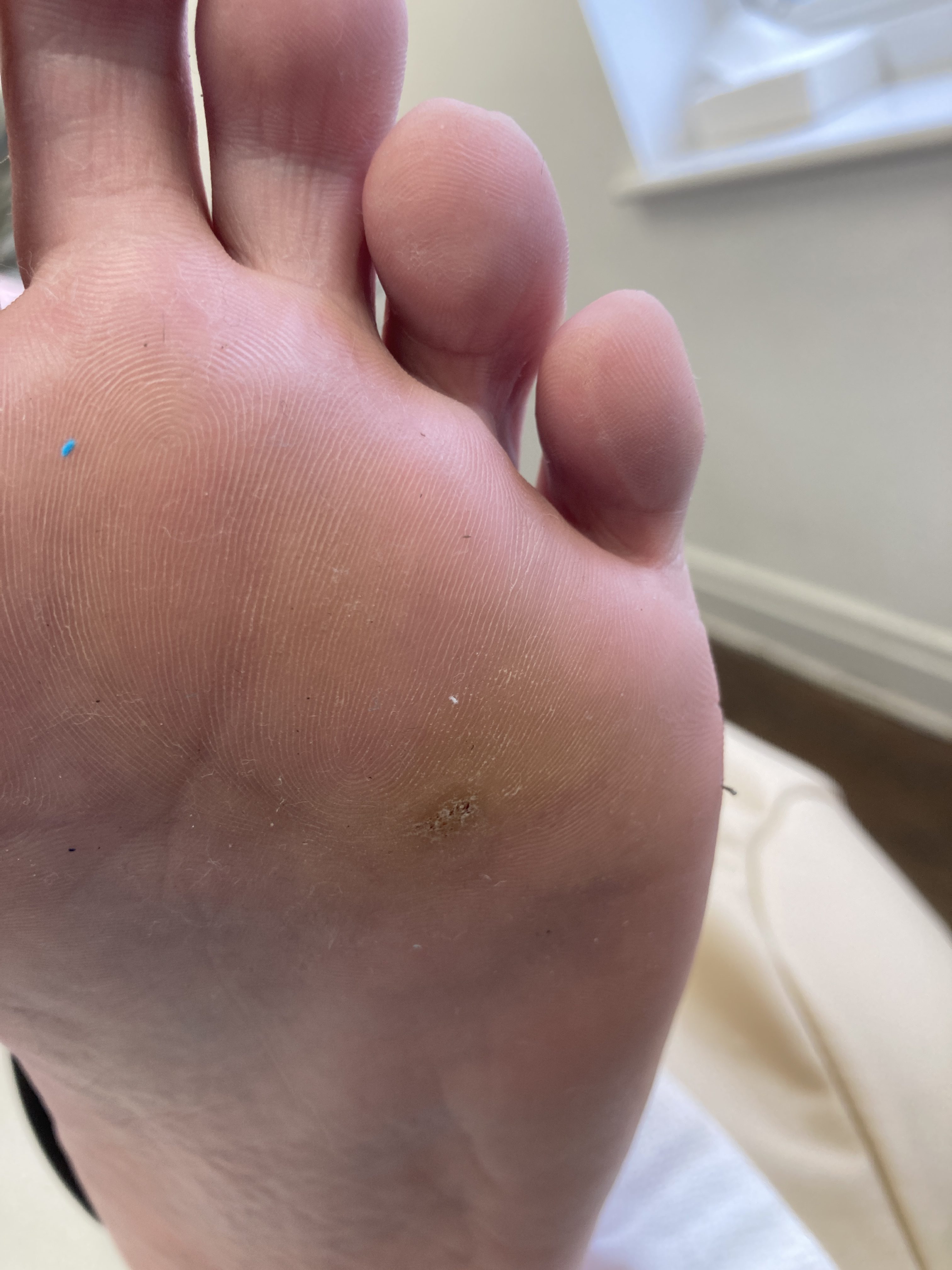 Professional verruca assessment and treatment at a podiatry clinic